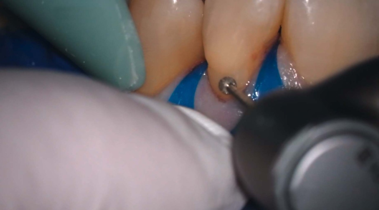 Treatment using the Fluorescence Mode Treatment using the Fluorescence Mode